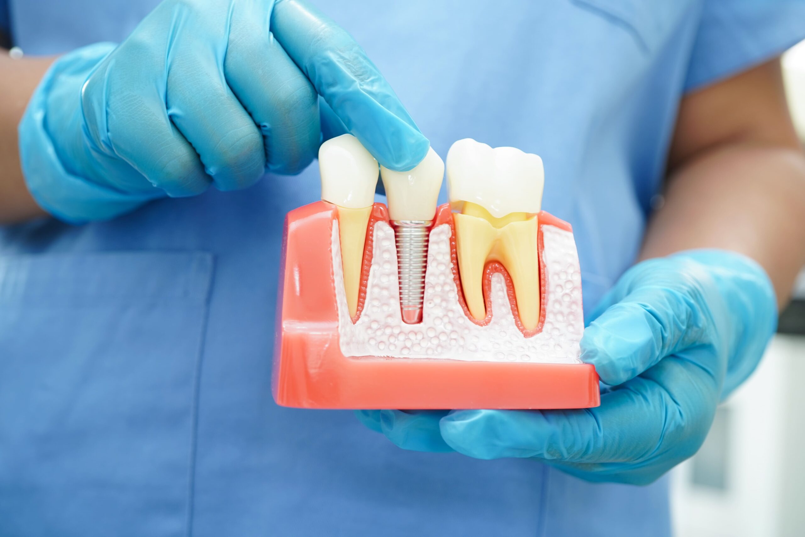 Dental Implants and ORAl Hygiene: Maintaining Health Around Implants