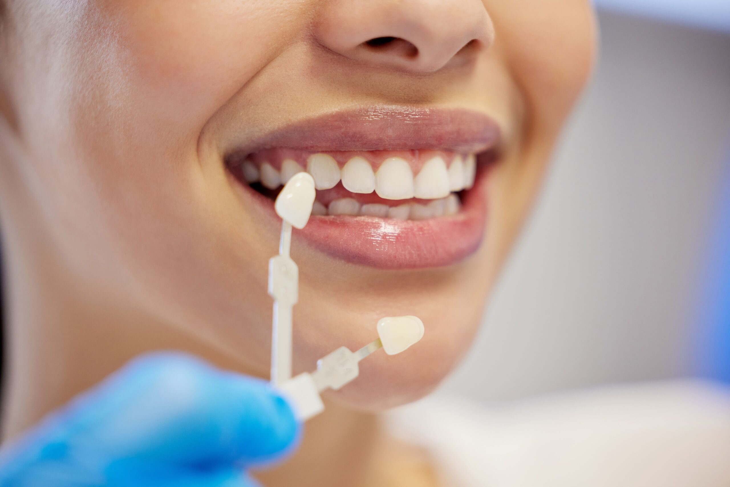 Step-by-Step Process of Getting Dental Veneers